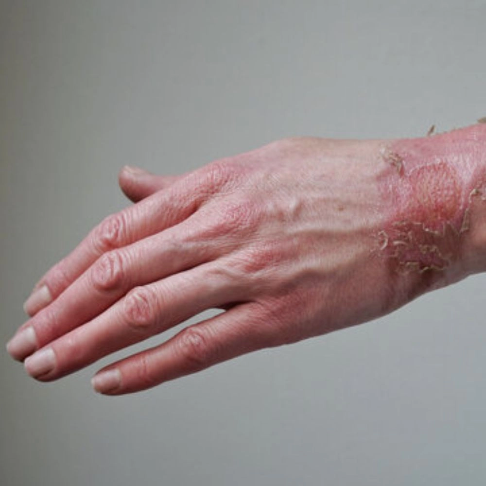 انواع سوختگی و 4 درجه سوختگی