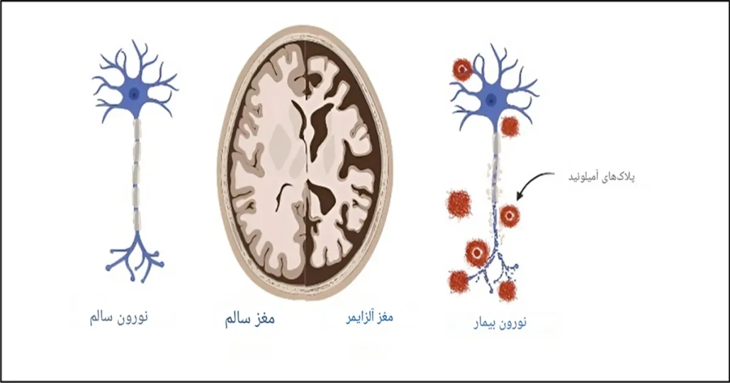 درمان‌های پیشرفته برای بیماری‌های عصبی مثل آلزایمر