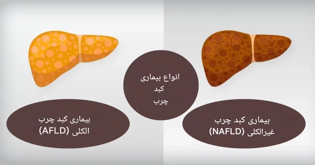 کبد چرب (گرید 1، 2 و 3) 2 کبد چرب (گرید 1، 2 و 3)