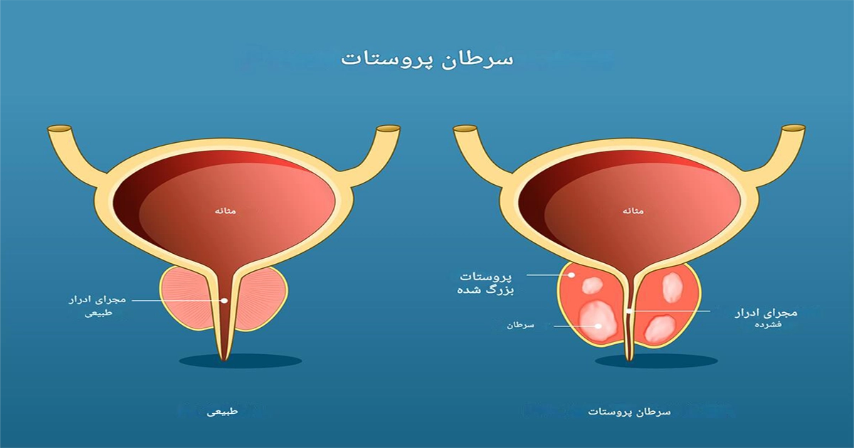 سرطان پروستات: علائم و درمان
