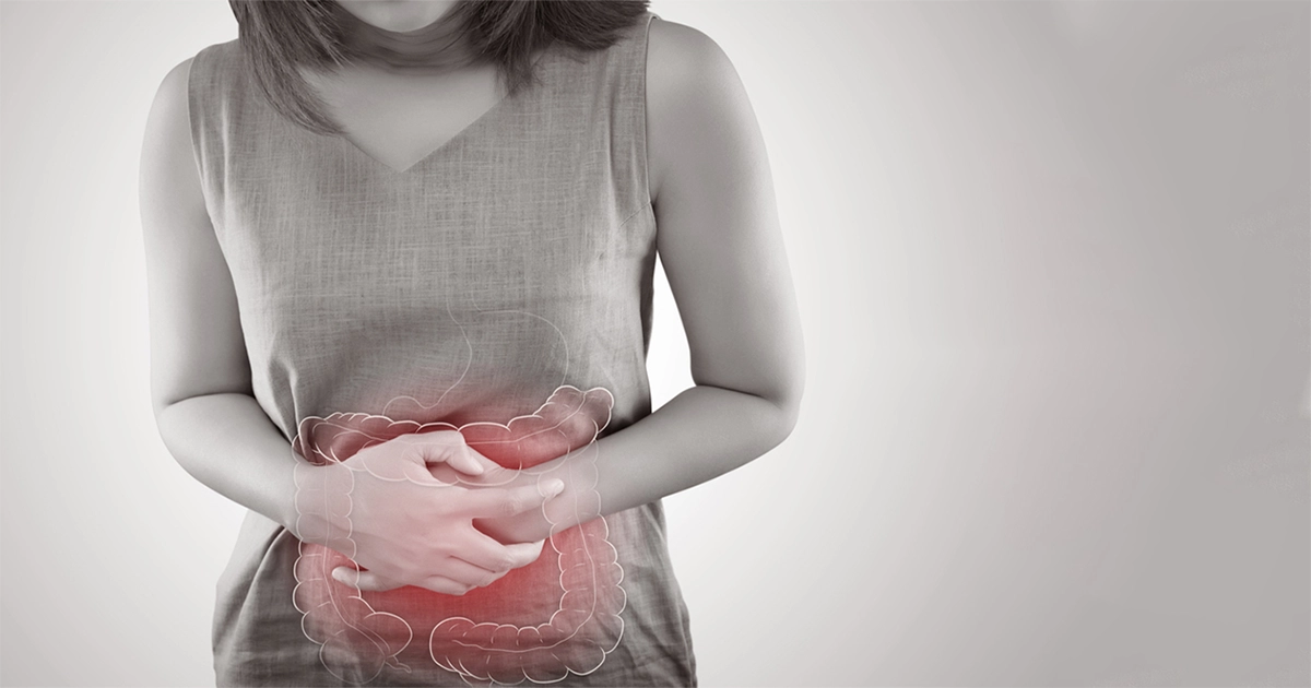 سندروم روده تحریک‌ پذیر (IBS)