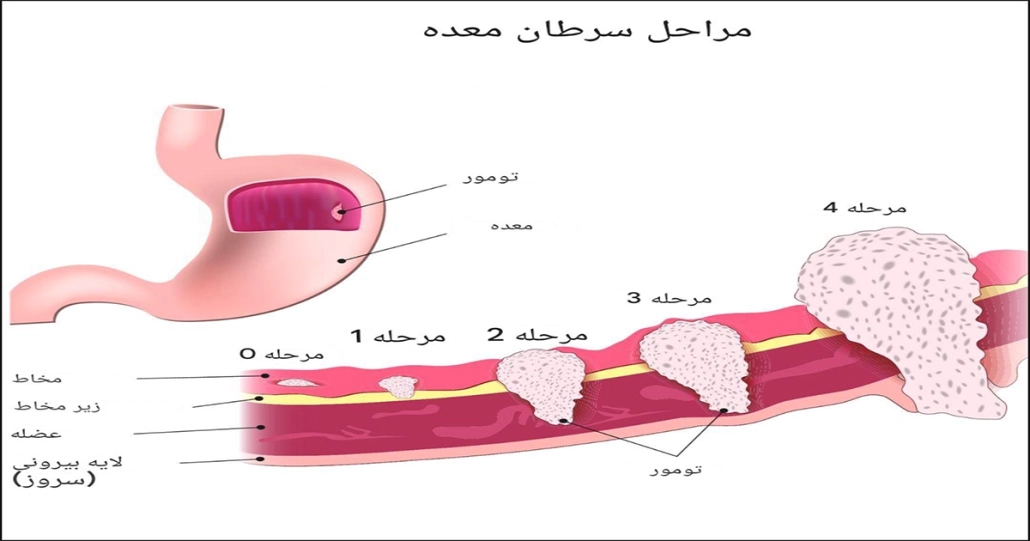 سرطان معده | از علائم تا درمان 2 سرطان معده
