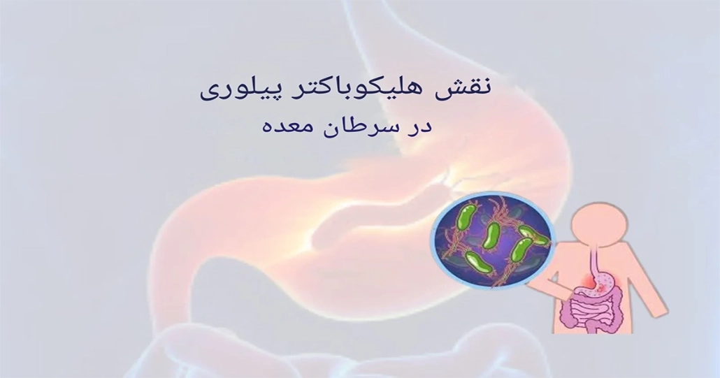 سرطان معده | از علائم تا درمان 4 سرطان معده