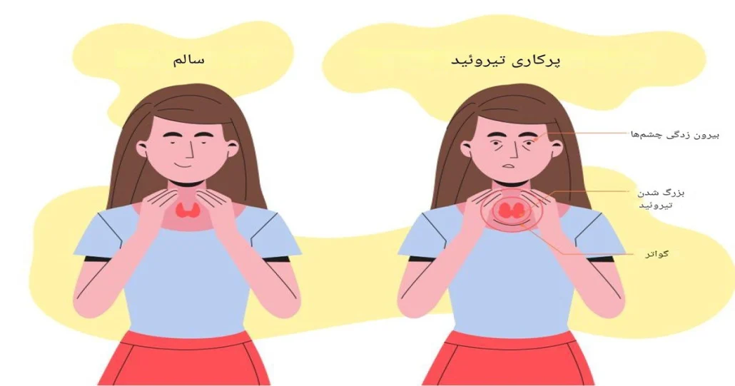 علائم پرکاری تیروئید 2 علائم پرکاری تیروئید