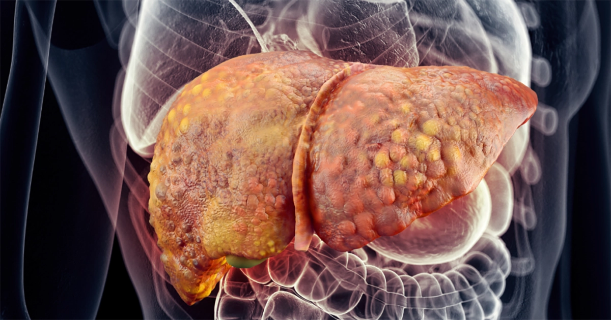 کبد چرب (گرید 1، 2 و 3)