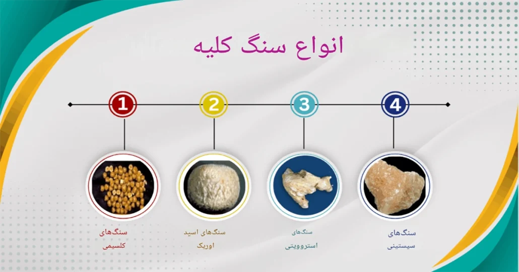 علائم سنگ کلیه، درمان و دفع