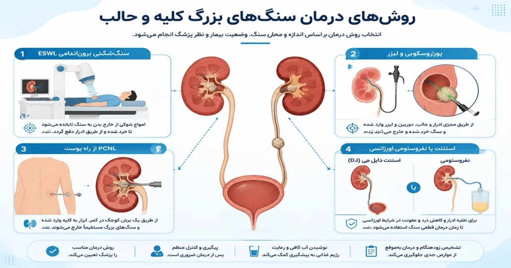 علائم سنگ کلیه، درمان و دفع